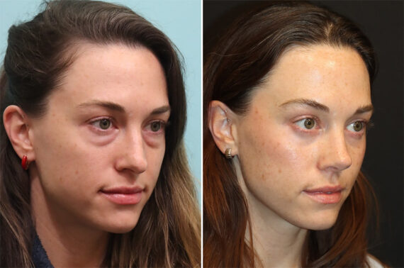 Before and after Rhinoplasty by Dr. Shervin Naderi, Patient 36401