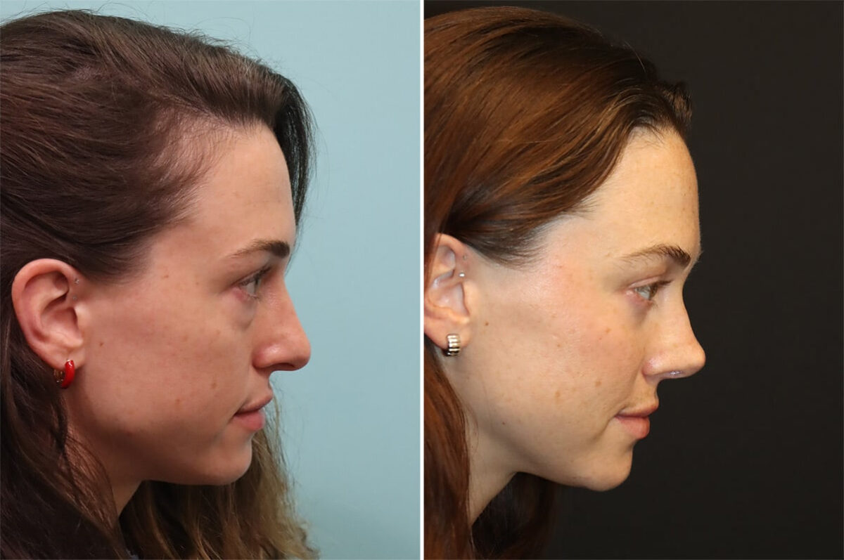 Patient 36401, Rhinoplasty Before and After Photos Before and after Rhinoplasty by Dr. Shervin Naderi, Patient 36401
