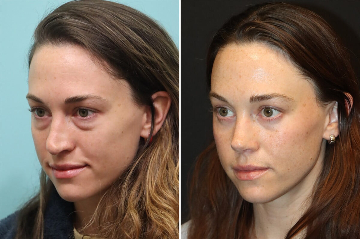 Patient 36401, Rhinoplasty Before and After Photos Before and after Rhinoplasty by Dr. Shervin Naderi, Patient 36401