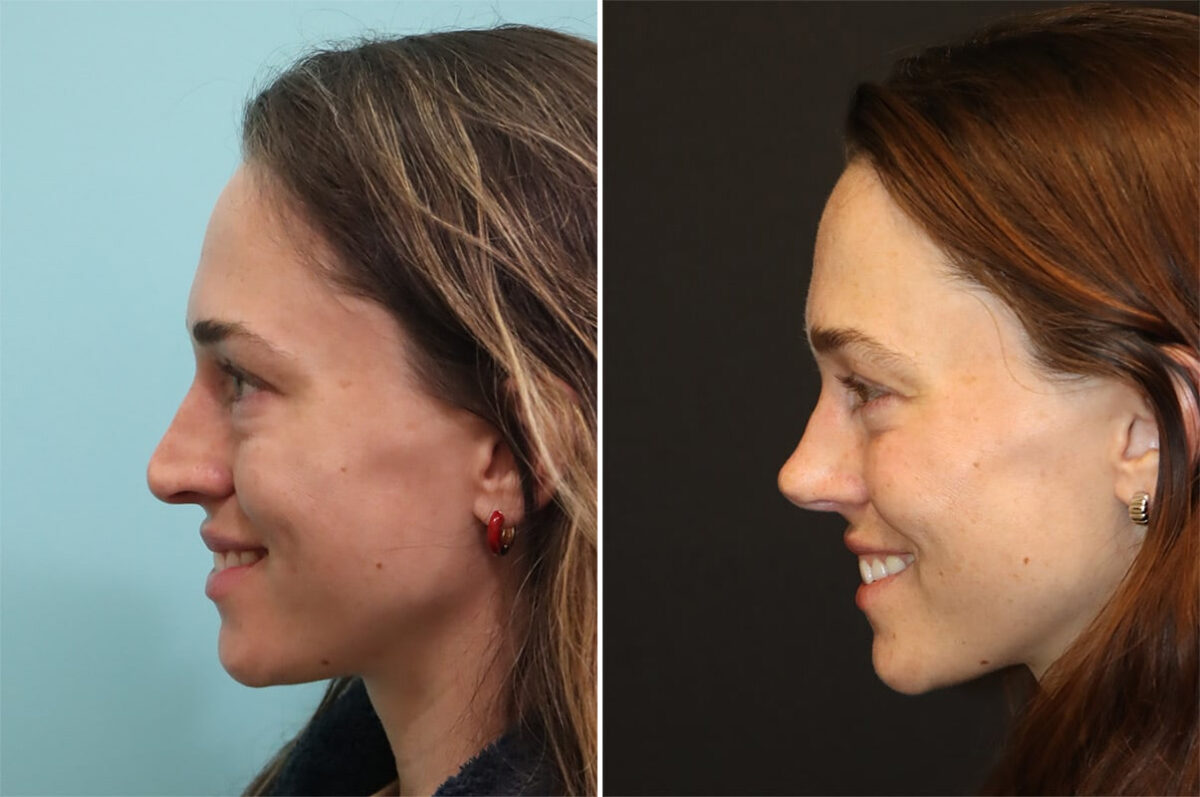 Patient 36401, Rhinoplasty Before and After Photos Before and after Rhinoplasty by Dr. Shervin Naderi, Patient 36401