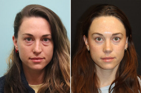 Before and after Rhinoplasty by Dr. Shervin Naderi, Patient 36401