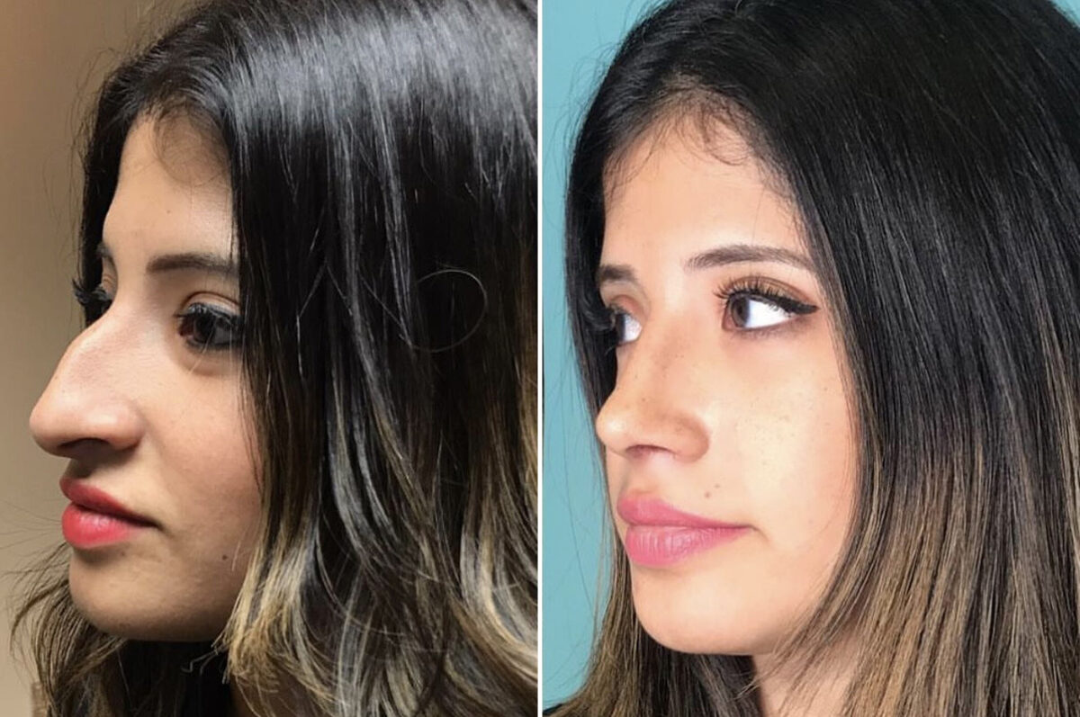 Before and after Rhinoplasty by Dr. Shervin Naderi, Patient 36693
