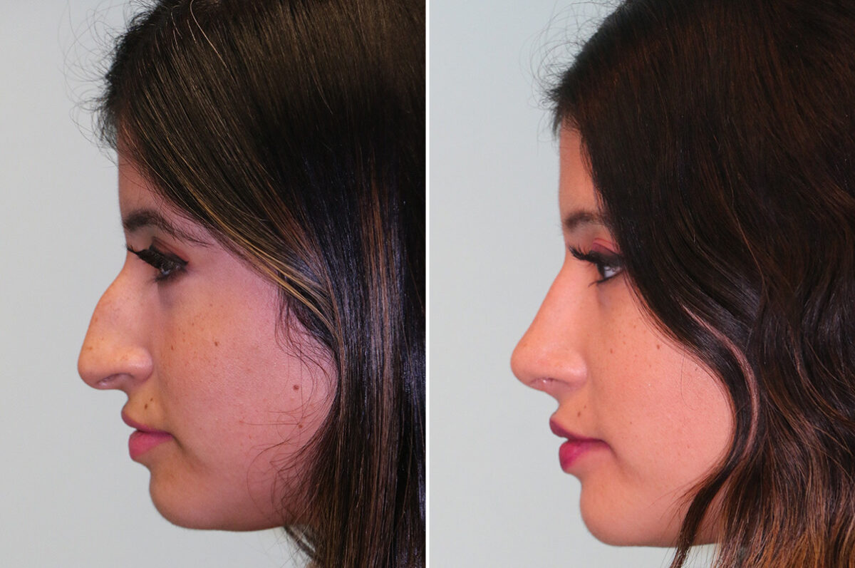 Before and after Rhinoplasty by Dr. Shervin Naderi, Patient 36693