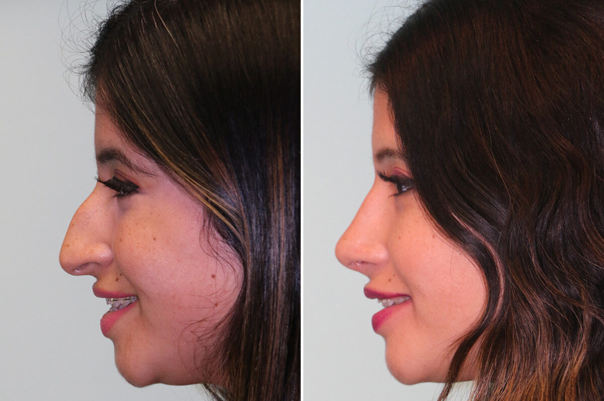Before and after Rhinoplasty by Dr. Shervin Naderi, Patient 36693
