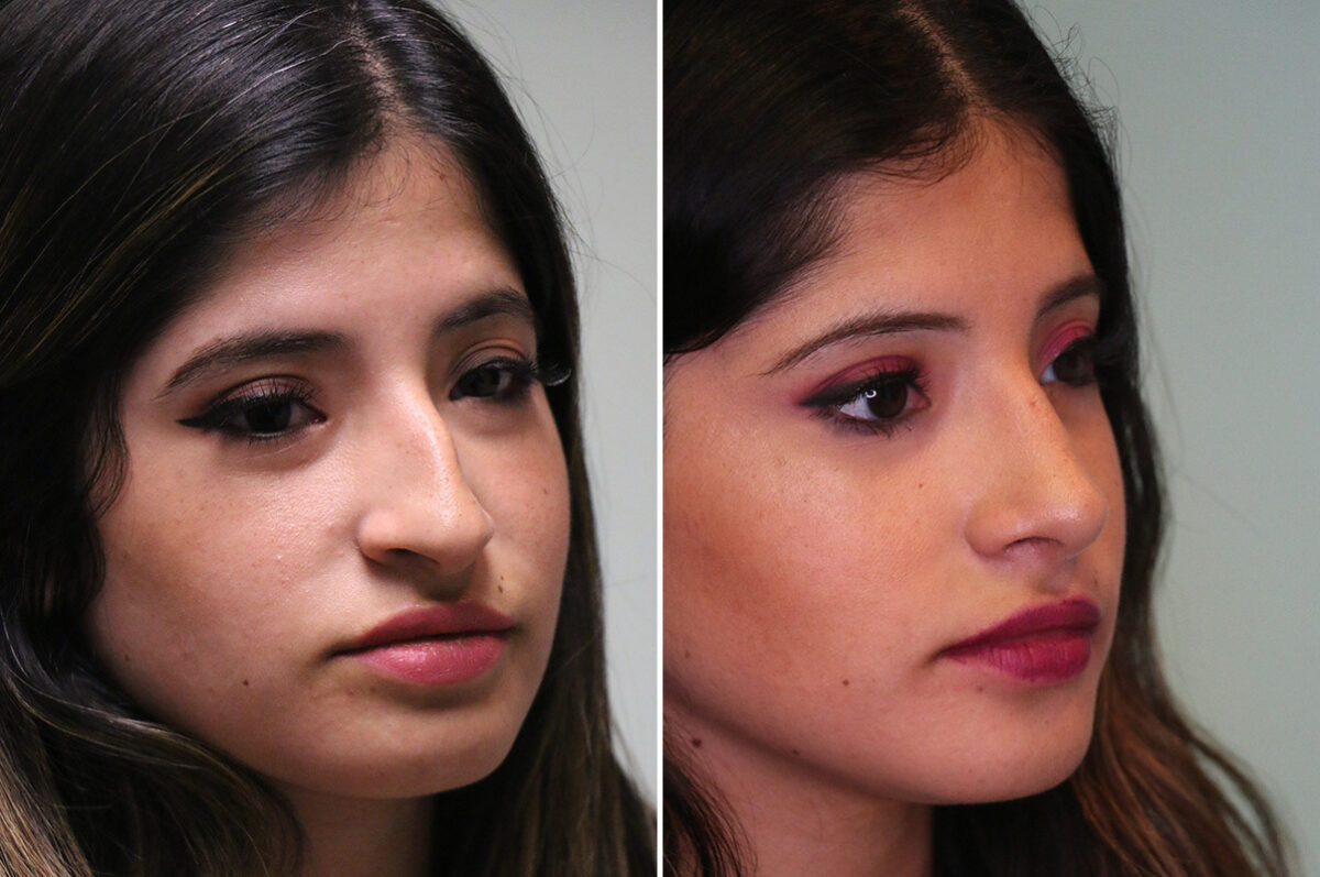 Before and after Rhinoplasty by Dr. Shervin Naderi, Patient 36693