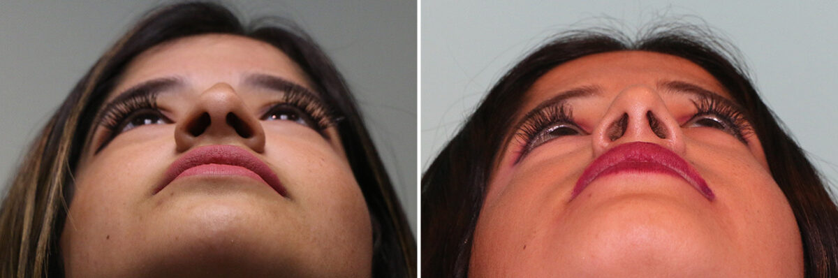 Before and after Rhinoplasty by Dr. Shervin Naderi, Patient 36693