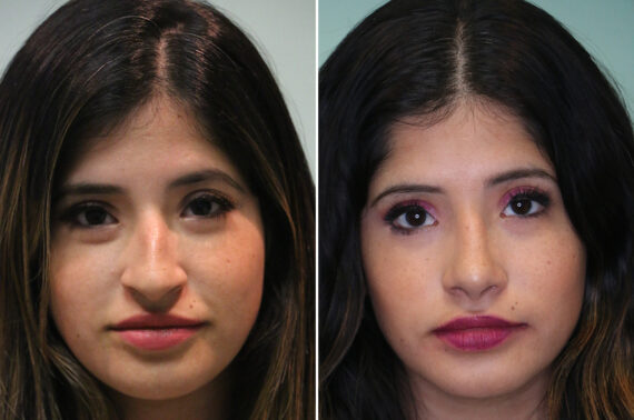 Thinking About Rhinoplasty in Turkey? Why Patient Safety and Informed Decisions Matter,  Before and After Photos Before and after Rhinoplasty by Dr. Shervin Naderi, Patient 36693
