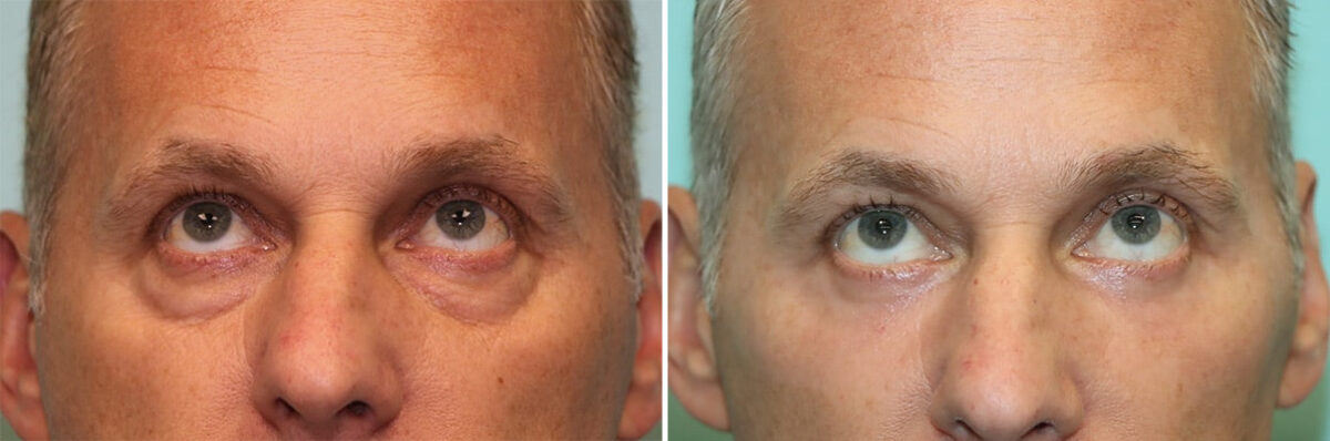 Before and after Blepharoplasty by Dr. Shervin Naderi, Patient 36959