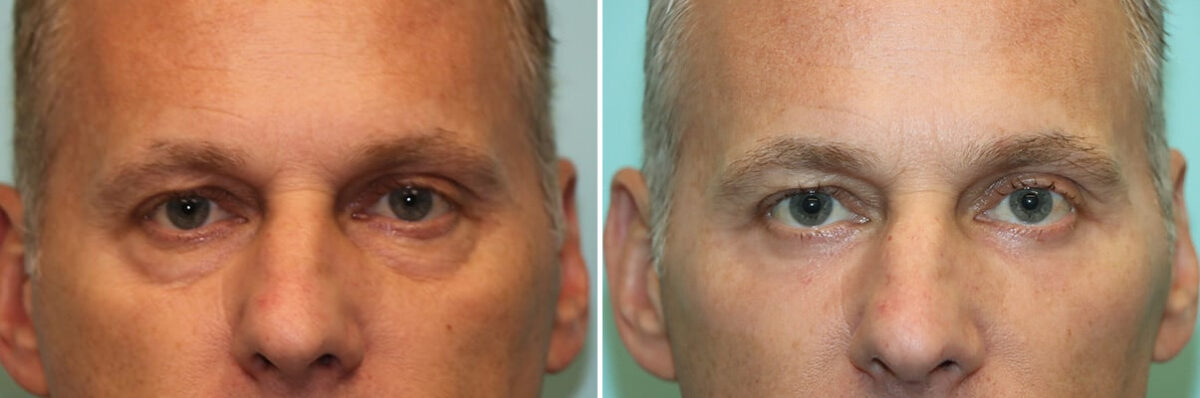Before and after Blepharoplasty by Dr. Shervin Naderi, Patient 36959