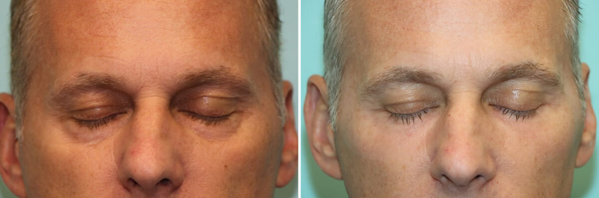 Before and after Blepharoplasty by Dr. Shervin Naderi, Patient 36959
