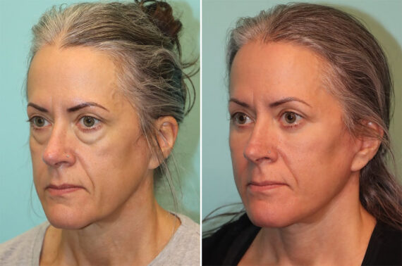Before and after Blepharoplasty by Dr. Shervin Naderi, Patient 37014