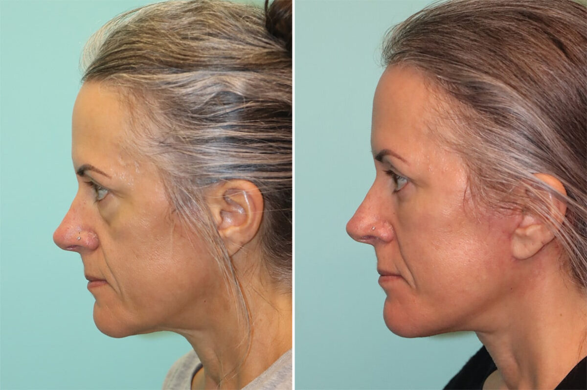 Patient 37014, Blepharoplasty Before and After Photos Before and after Blepharoplasty by Dr. Shervin Naderi, Patient 37014