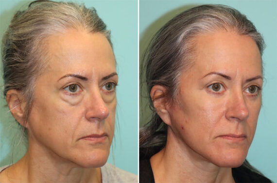 Before and after Blepharoplasty by Dr. Shervin Naderi, Patient 37014