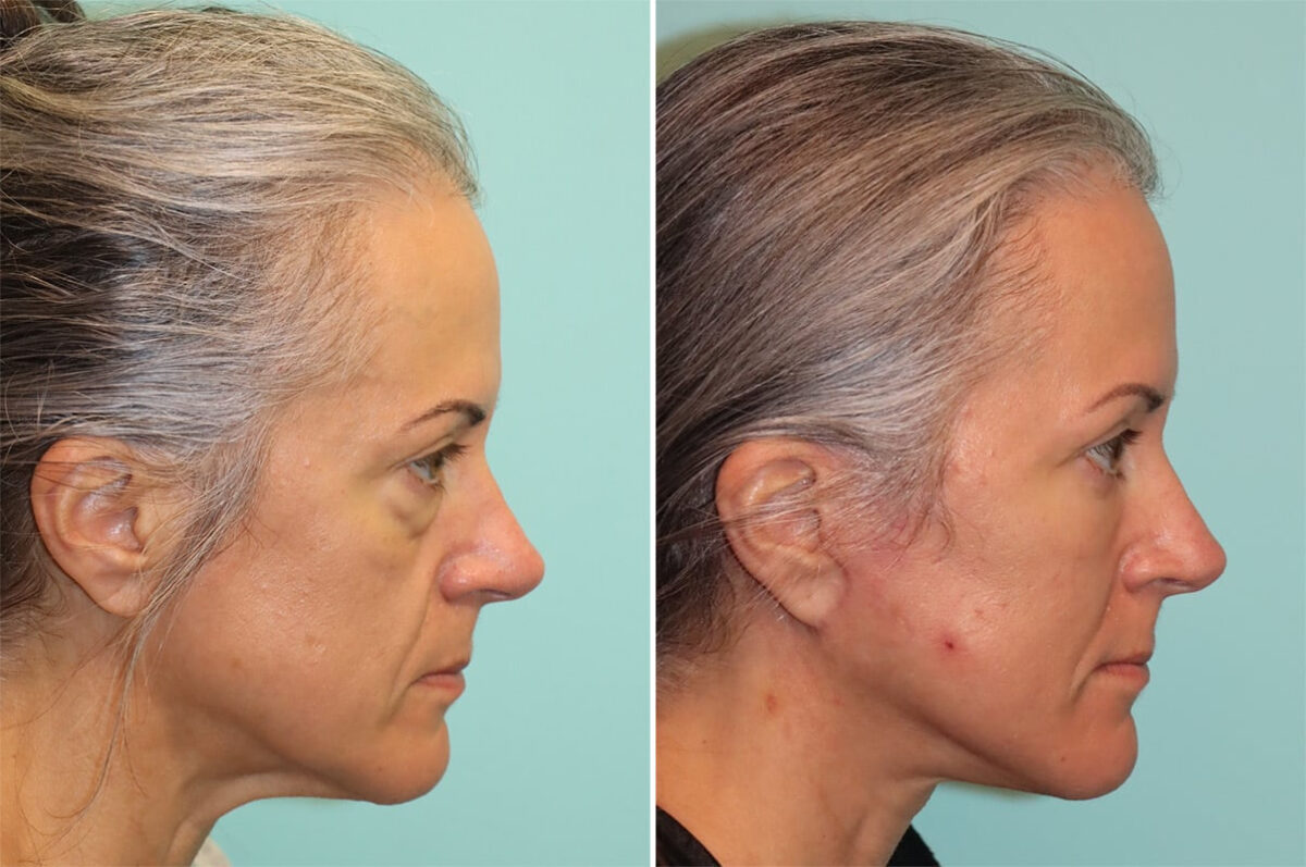 Patient 37014, Blepharoplasty Before and After Photos Before and after Blepharoplasty by Dr. Shervin Naderi, Patient 37014