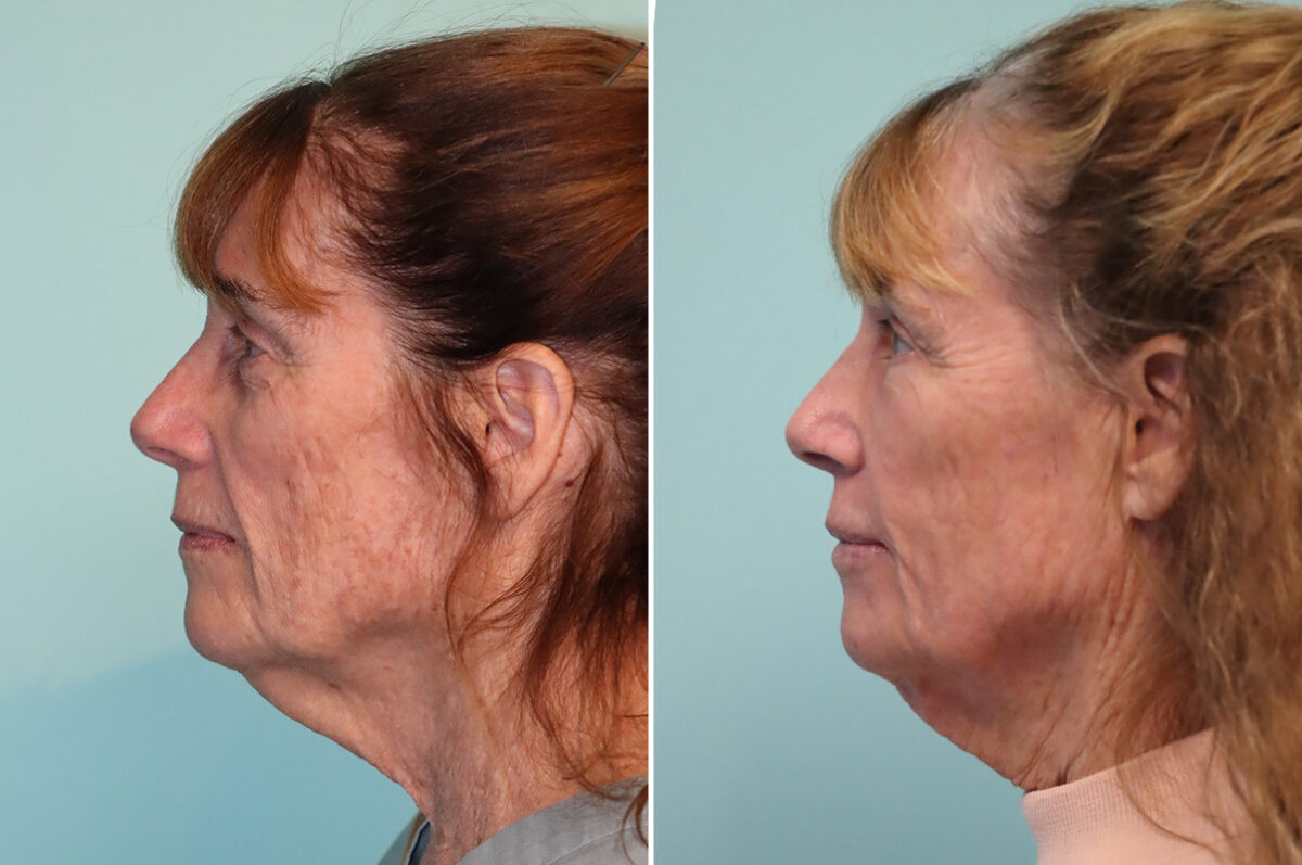 Patient 37839, Fat Transfer Before and After Photos Before and after Fat Transfer by Dr. Shervin Naderi, Patient 37839