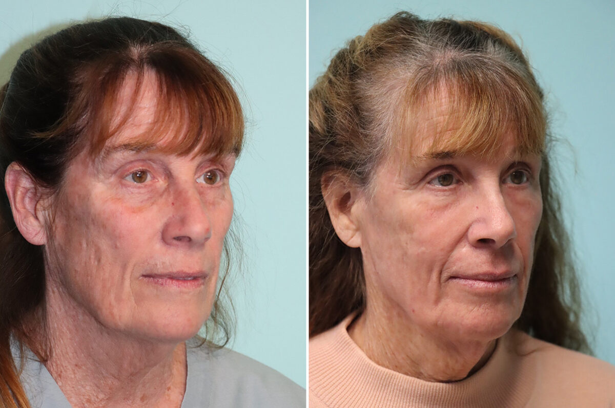 Patient 37839, Fat Transfer Before and After Photos Before and after Fat Transfer by Dr. Shervin Naderi, Patient 37839