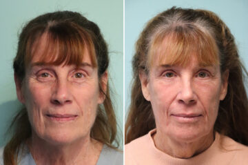 Before and after Fat Transfer by Dr. Shervin Naderi, Patient 37839