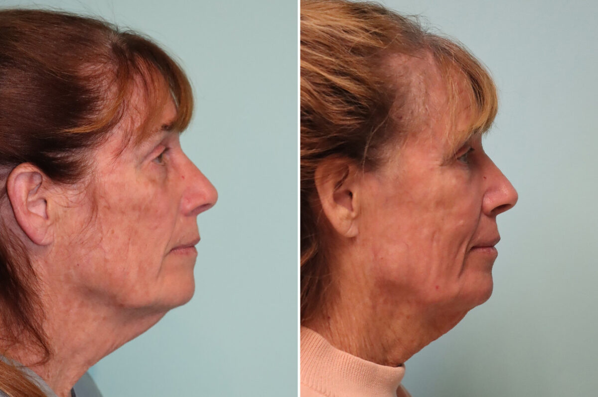 Patient 37839, Fat Transfer Before and After Photos Before and after Fat Transfer by Dr. Shervin Naderi, Patient 37839
