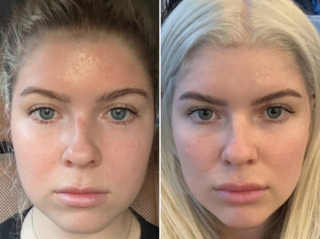 Before and after Botox Injections by Dr. Shervin Naderi, Patient 44703