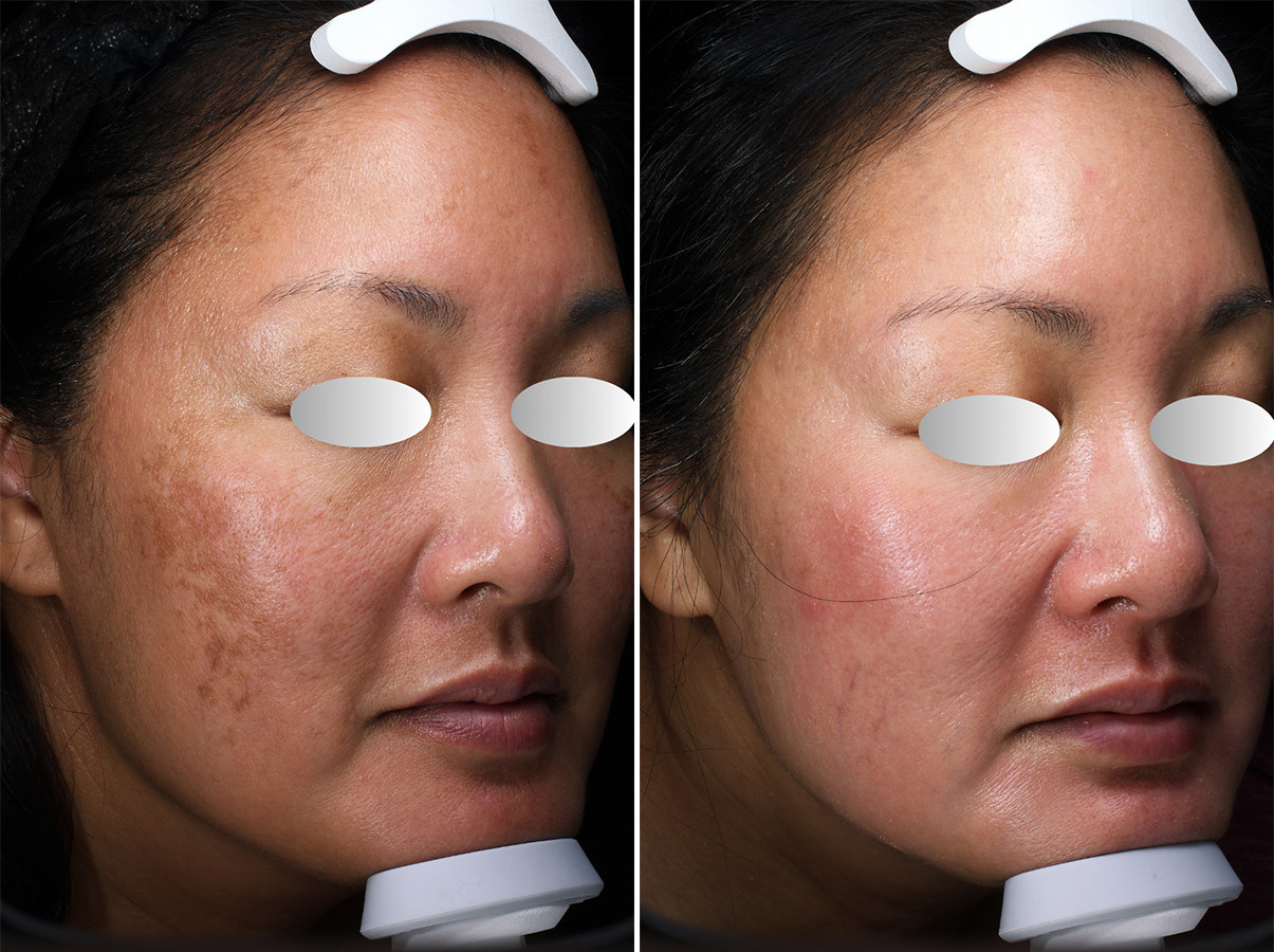 patient-44717-chemical-peels-before-after