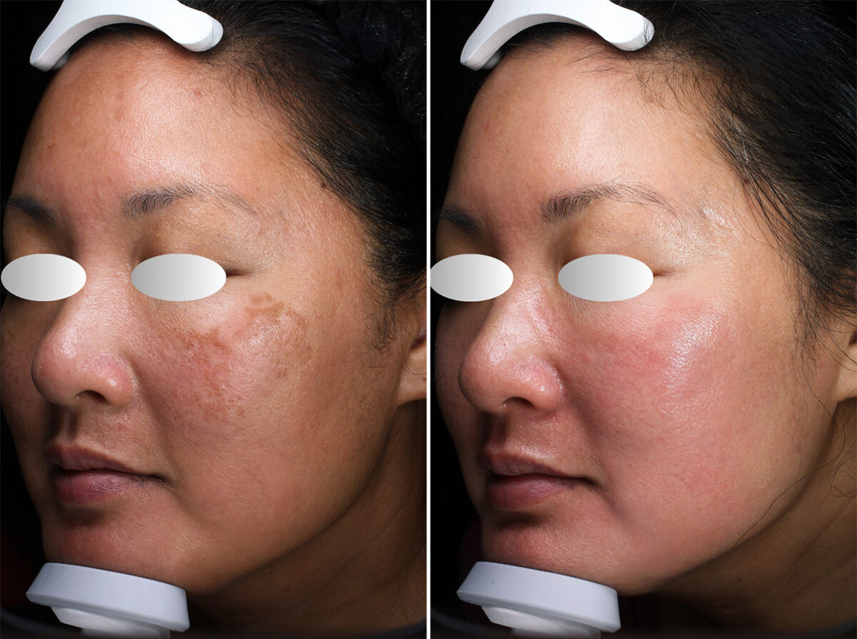 Before and after Chemical Peels by Dr. Shervin Naderi, Patient 44717
