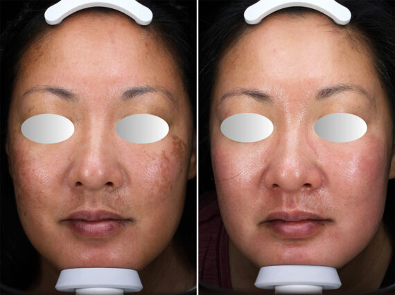 Before and after Chemical Peels by Dr. Shervin Naderi, Patient 44717
