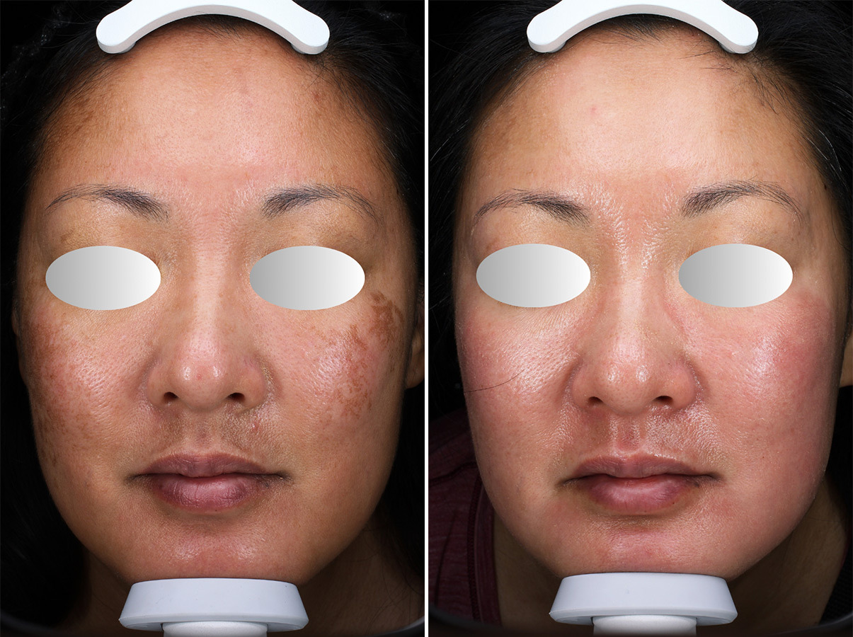 patient-44717-chemical-peels-before-after