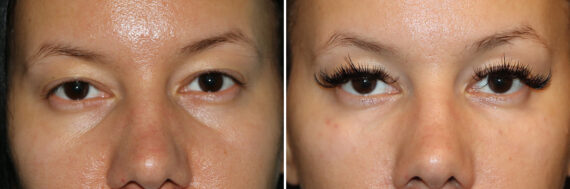 Before and after Tear Trough / Under Eye Injections by Dr. Shervin Naderi, Patient 44721