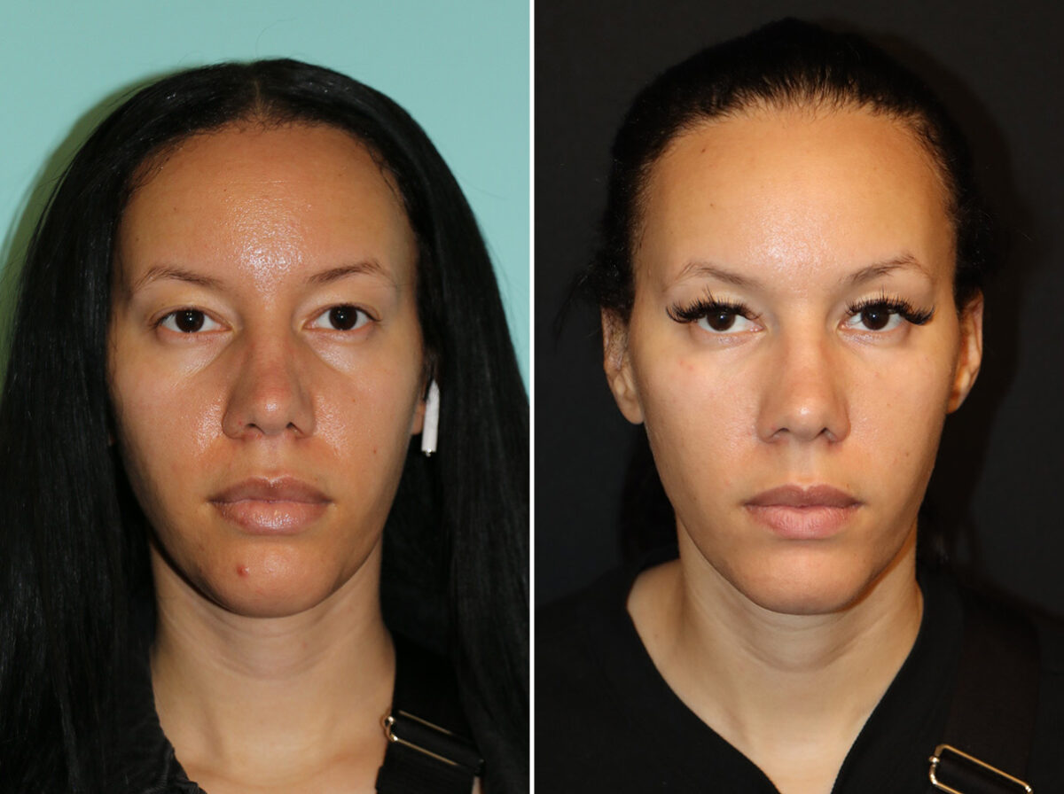 Before and after Tear Trough / Under Eye Injections by Dr. Shervin Naderi, Patient 44721