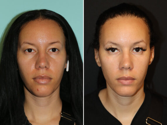 Before and after Tear Trough / Under Eye Injections by Dr. Shervin Naderi, Patient 44721