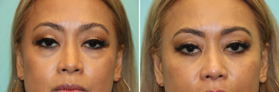 Before and after Blepharoplasty by Dr. Shervin Naderi, Patient 44724