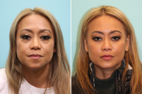 Before and after Blepharoplasty by Dr. Shervin Naderi, Patient 44724