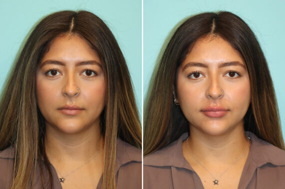 Before and after Lip Augmentation by Dr. Shervin Naderi, Patient 44735