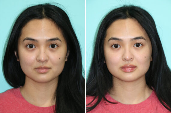 Before and after Lip Augmentation by Dr. Shervin Naderi, Patient 44737