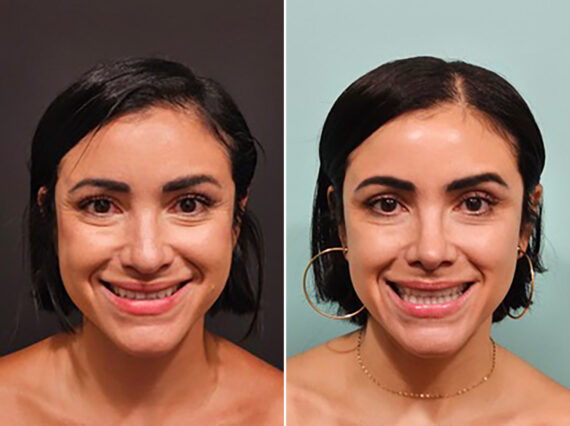 Before and after Rhinoplasty by Dr. Shervin Naderi, Patient 44739