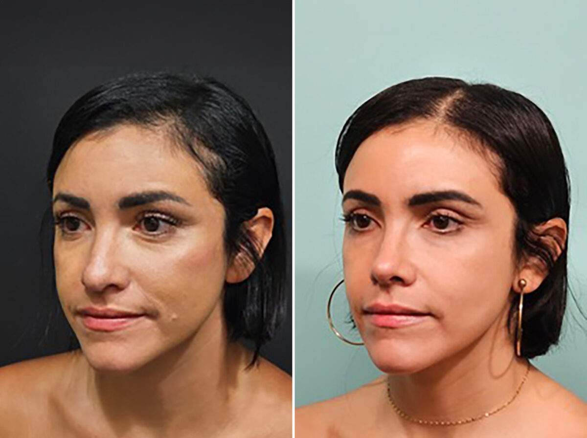 Before and after Rhinoplasty by Dr. Shervin Naderi, Patient 44739