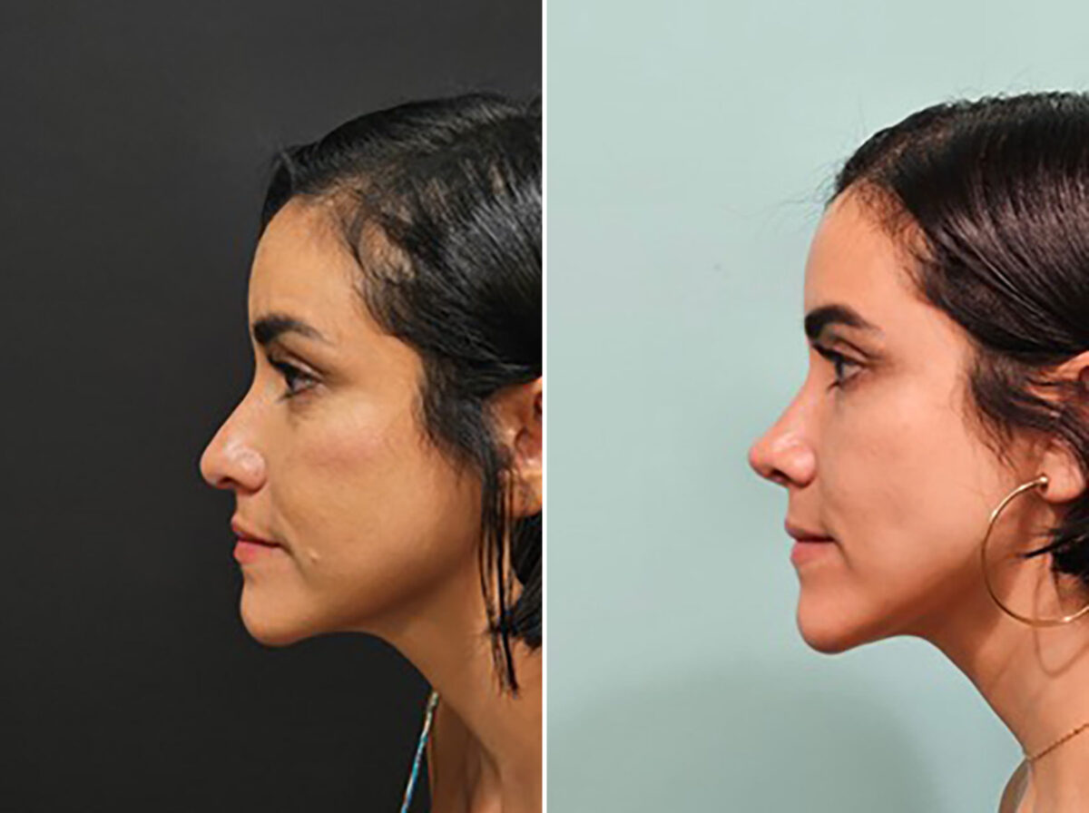 Before and after Rhinoplasty by Dr. Shervin Naderi, Patient 44739