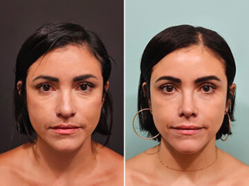 Before and after Rhinoplasty by Dr. Shervin Naderi, Patient 44739