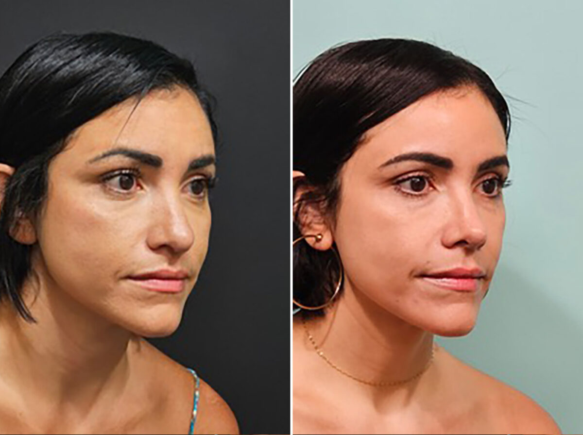 Before and after Rhinoplasty by Dr. Shervin Naderi, Patient 44739