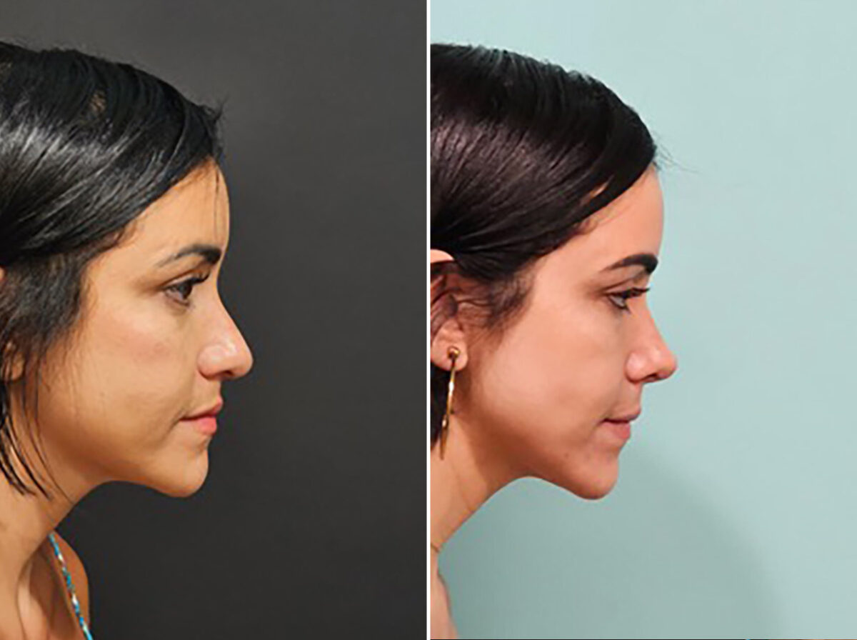 Before and after Rhinoplasty by Dr. Shervin Naderi, Patient 44739
