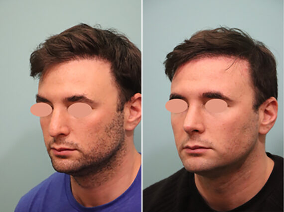 Before and after Rhinoplasty by Dr. Shervin Naderi, Patient 44758