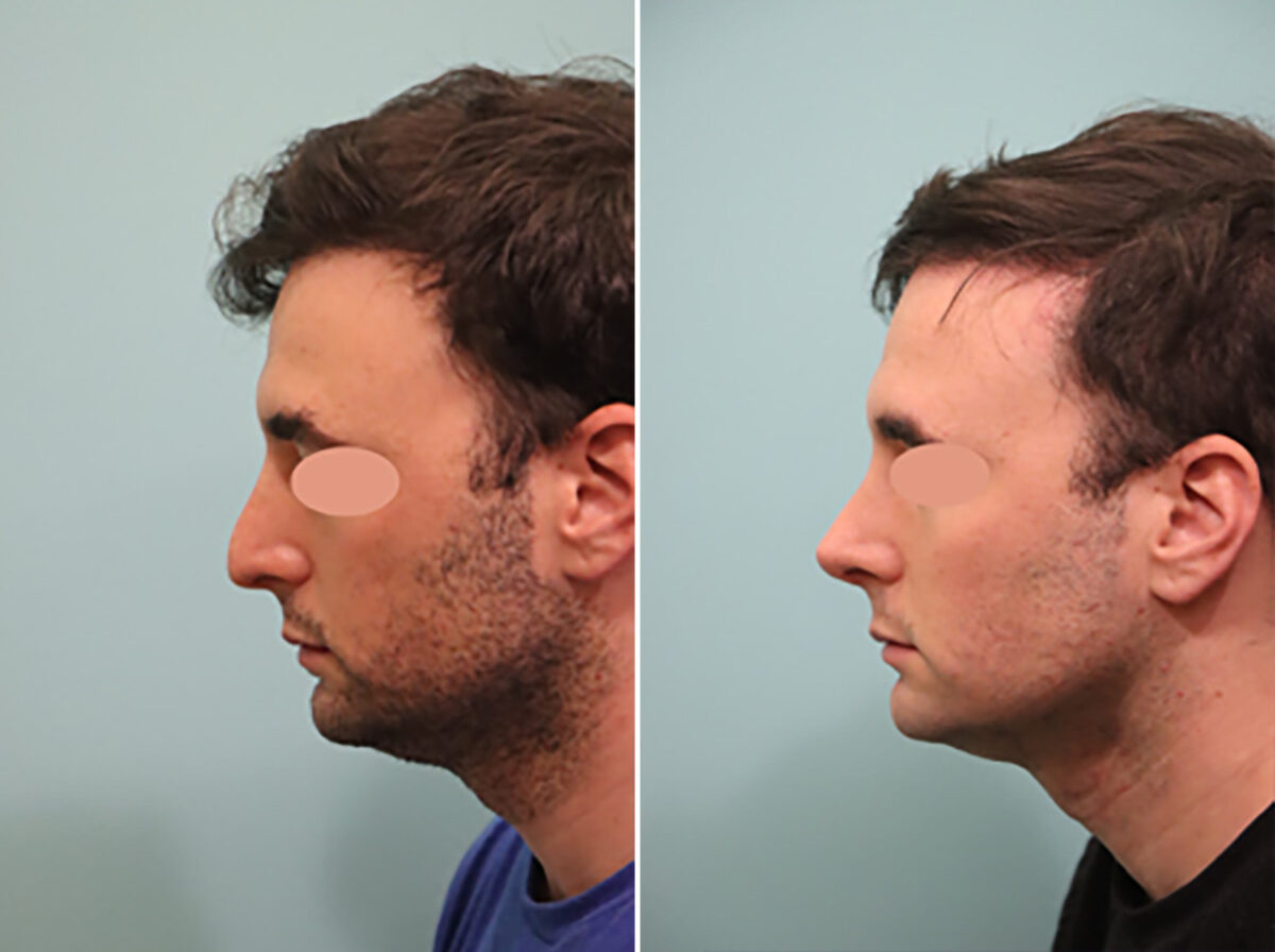 Before and after Rhinoplasty by Dr. Shervin Naderi, Patient 44758