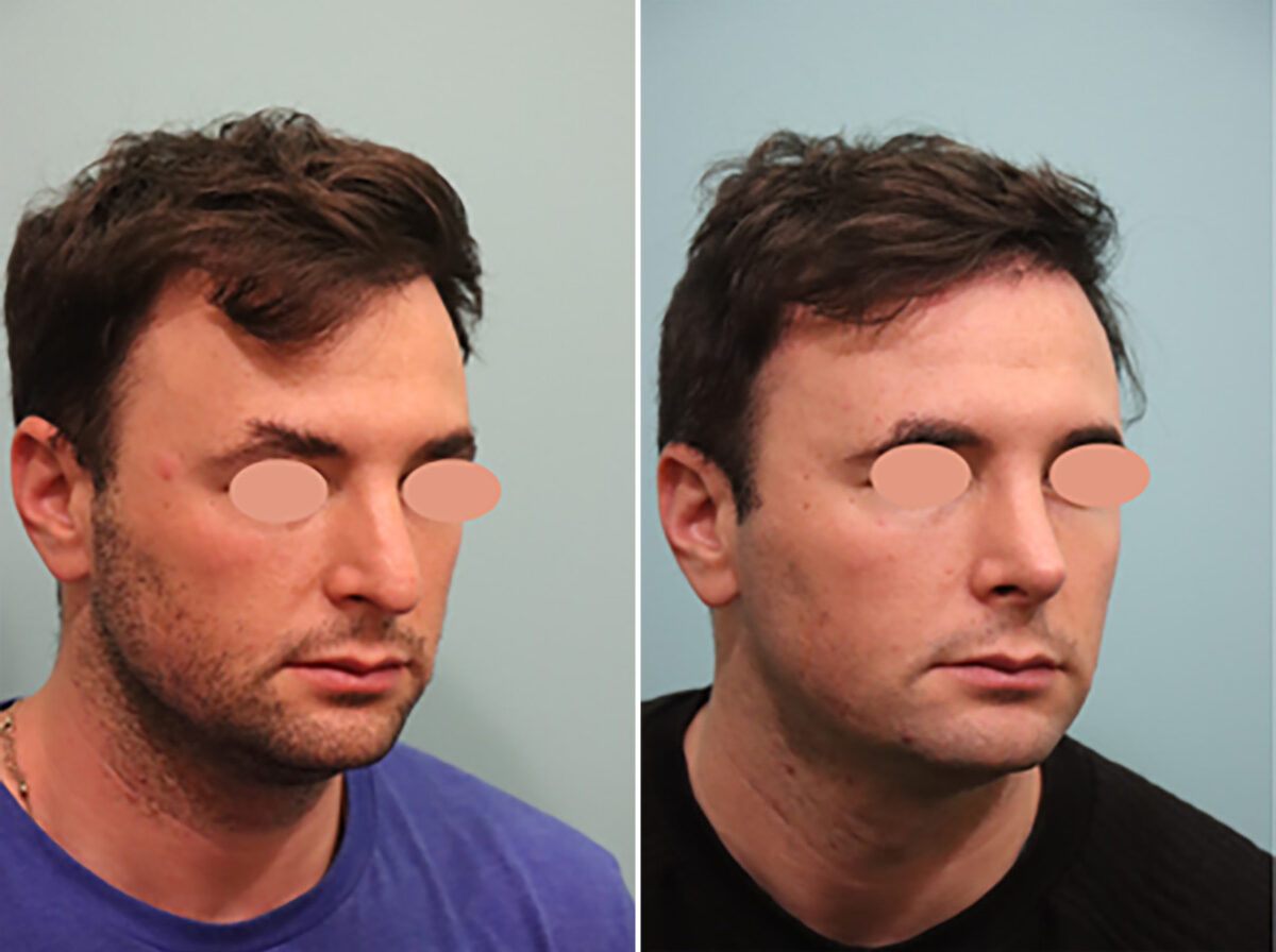 Before and after Rhinoplasty by Dr. Shervin Naderi, Patient 44758