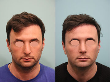 Before and after Rhinoplasty by Dr. Shervin Naderi, Patient 44758