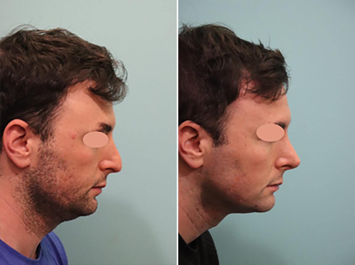 Before and after Rhinoplasty by Dr. Shervin Naderi, Patient 44758