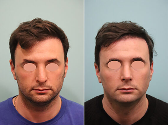 Before and after Rhinoplasty by Dr. Shervin Naderi, Patient 44758