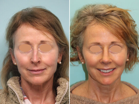 Before and after Rhinoplasty by Dr. Shervin Naderi, Patient 44774