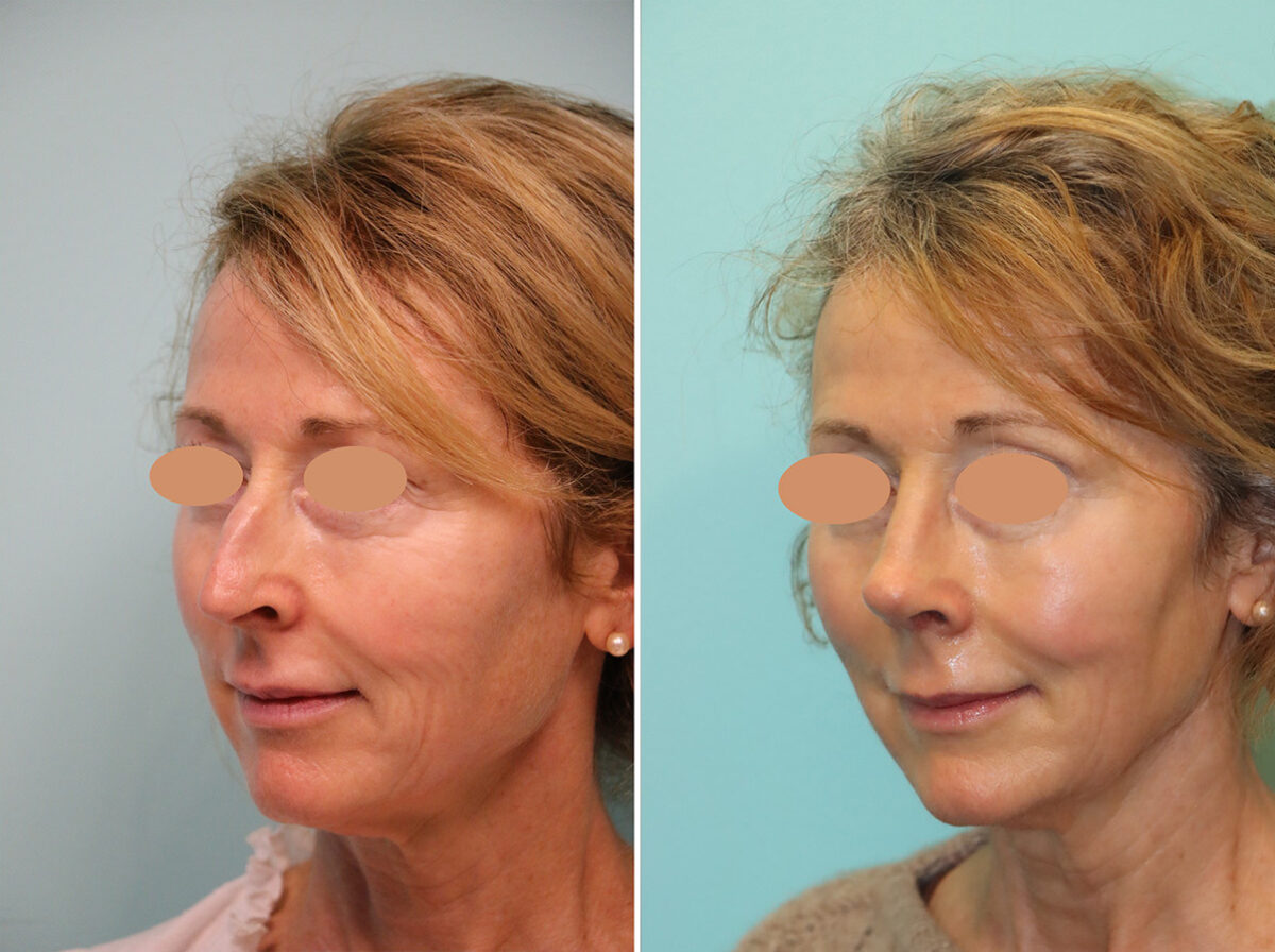 Before and after Rhinoplasty by Dr. Shervin Naderi, Patient 44774