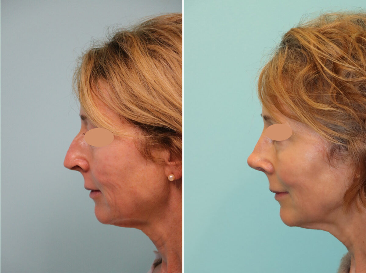 Before and after Rhinoplasty by Dr. Shervin Naderi, Patient 44774