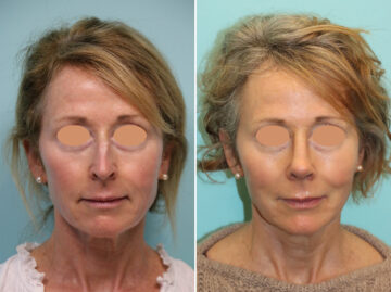 Before and after Rhinoplasty by Dr. Shervin Naderi, Patient 44774